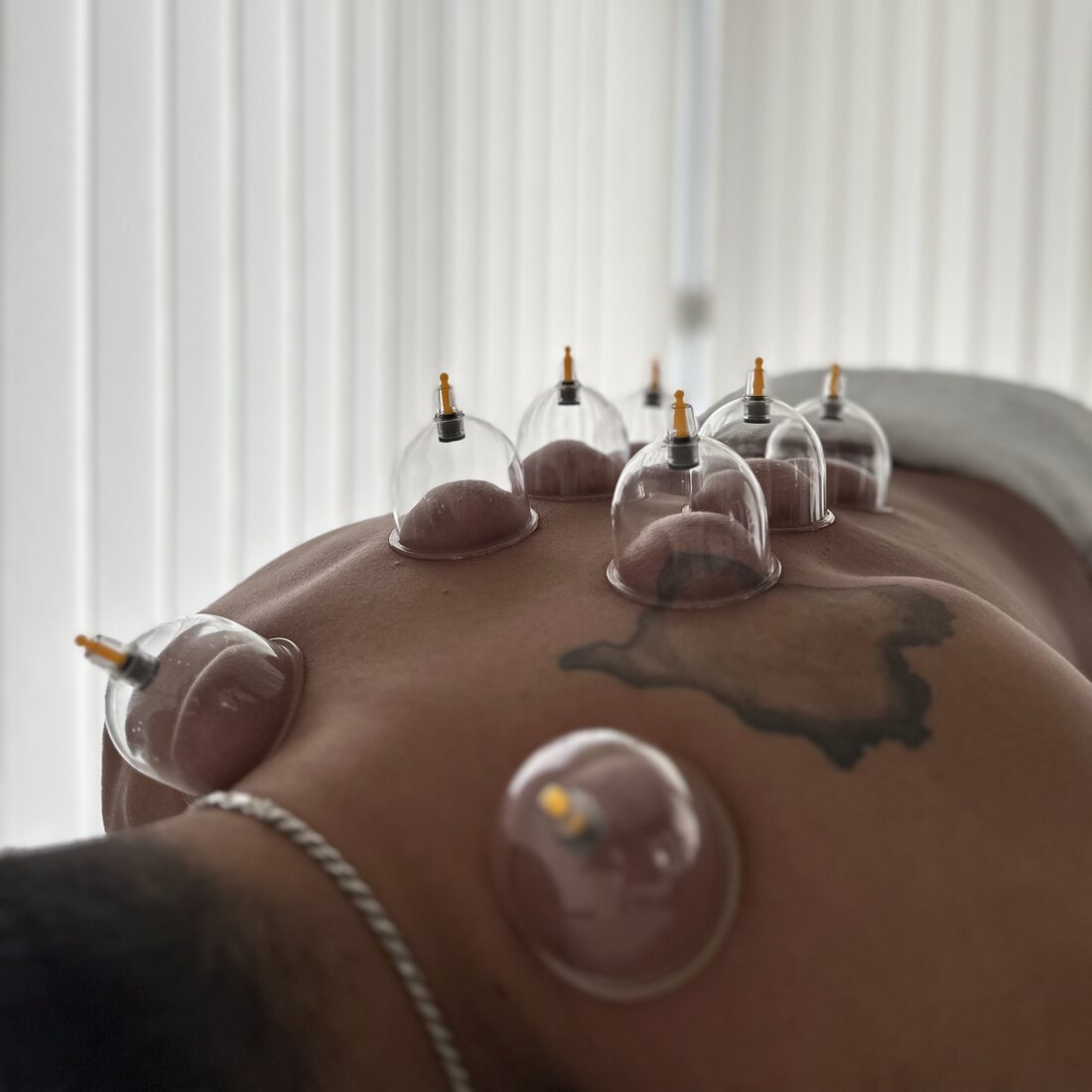 Våtkoppning hos The Hijama Studio